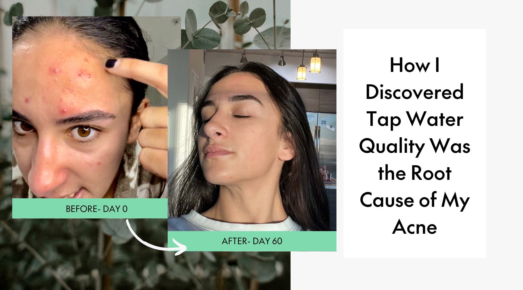 How I Discovered Tap Water Quality Was the Root Cause of my Acne 