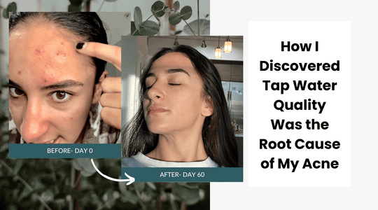 How I Discovered Tap Water Quality Was the Root Cause of my Acne