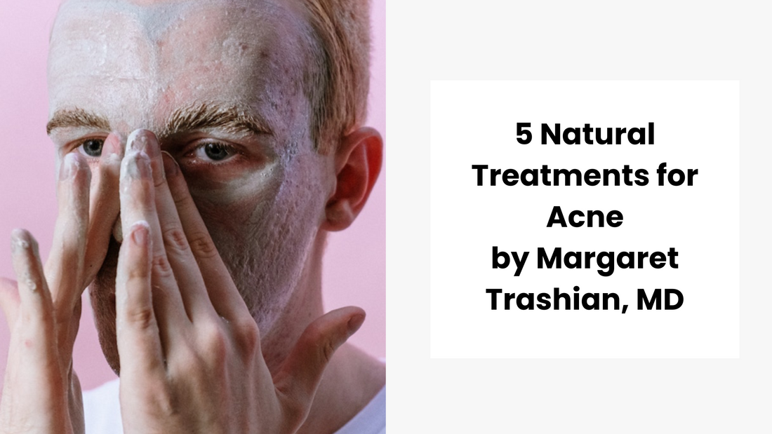 5 Natural Treatments for Acne