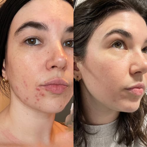 Can Tap Water Cause Acne? The Science, Explained